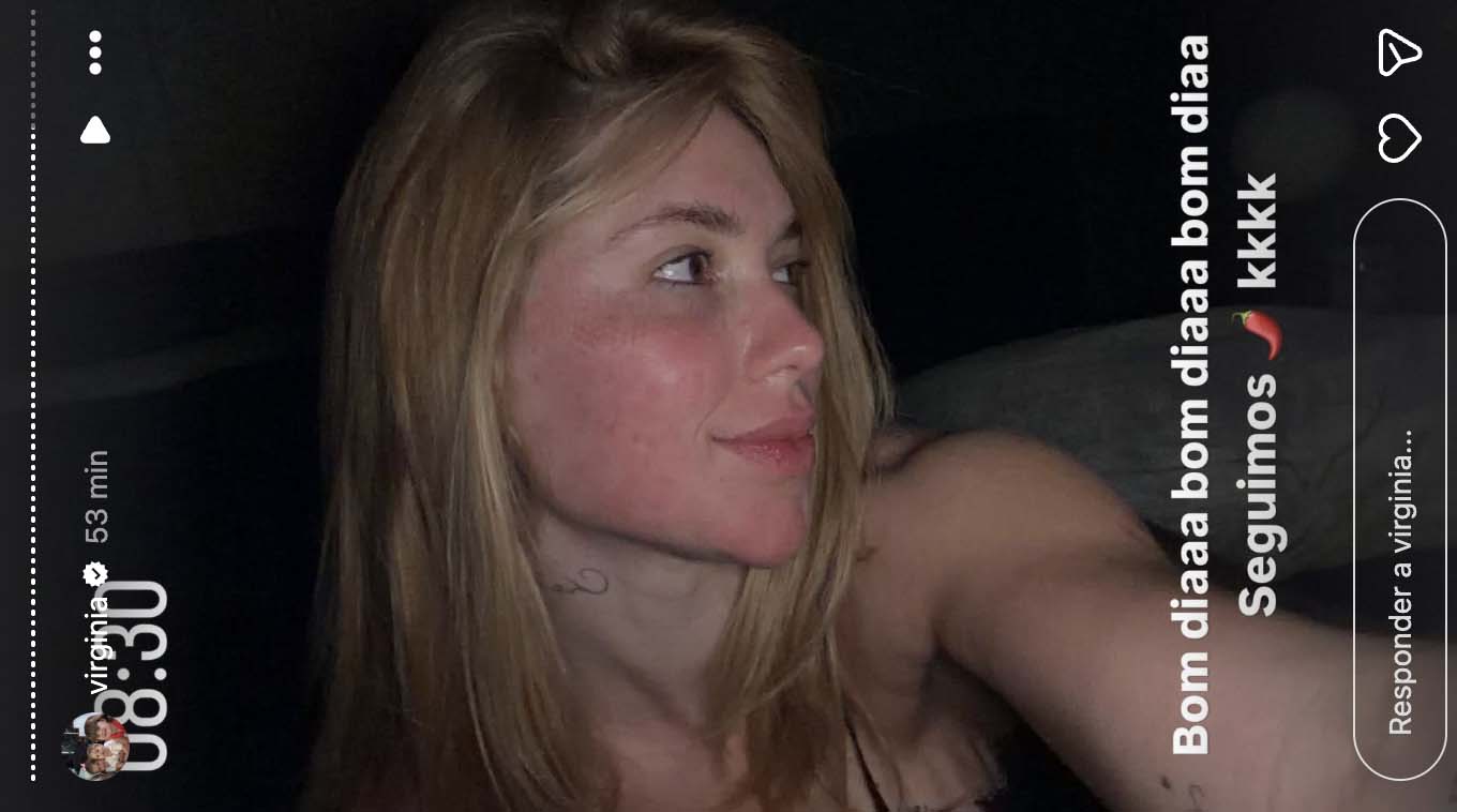 Virginia mostra sua aparência após passar por tratamento com laser - Foto: Reprodução / Instagram