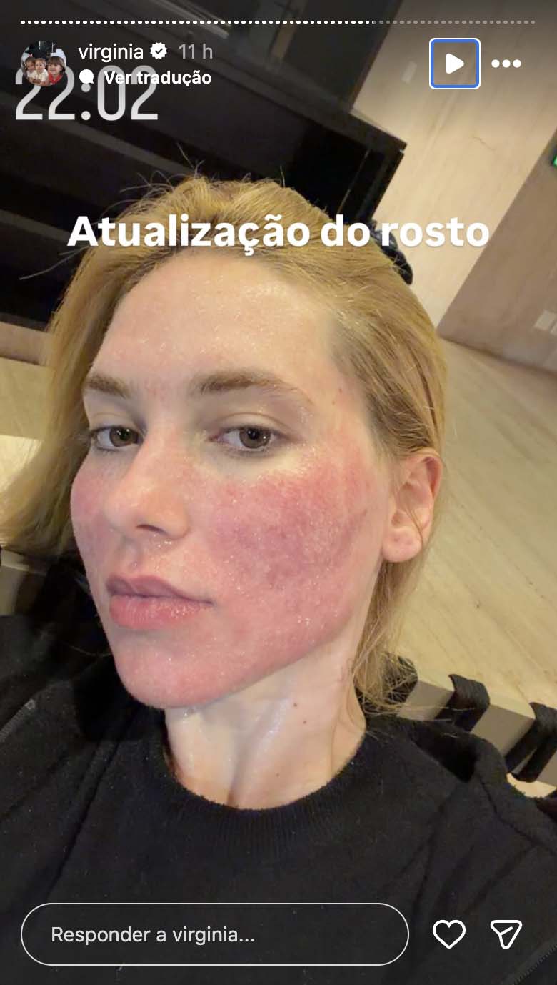 Virginia mostra sua aparência após passar por tratamento com laser - Foto: Reprodução / Instagram
