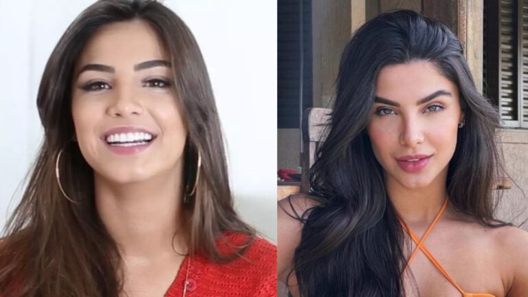Antes e depois de Gabriela Versiani divide a internet e levanta debate sobre harmonização facial, aponta médica