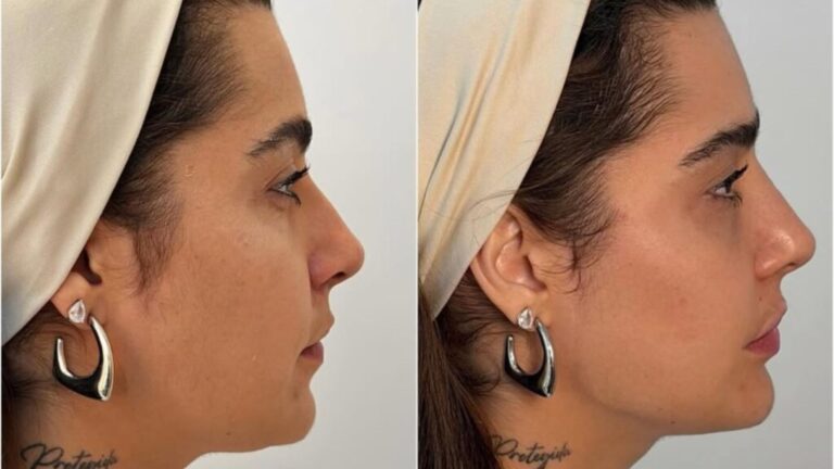 Antes e depois de Lauana Prado reacende debate sobre harmonização facial natural