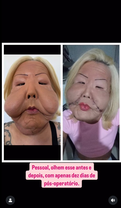 Influenciadora passou por cirurgia para retirar óleo mineral do rosto - Reprodução/Instagram @drmarra