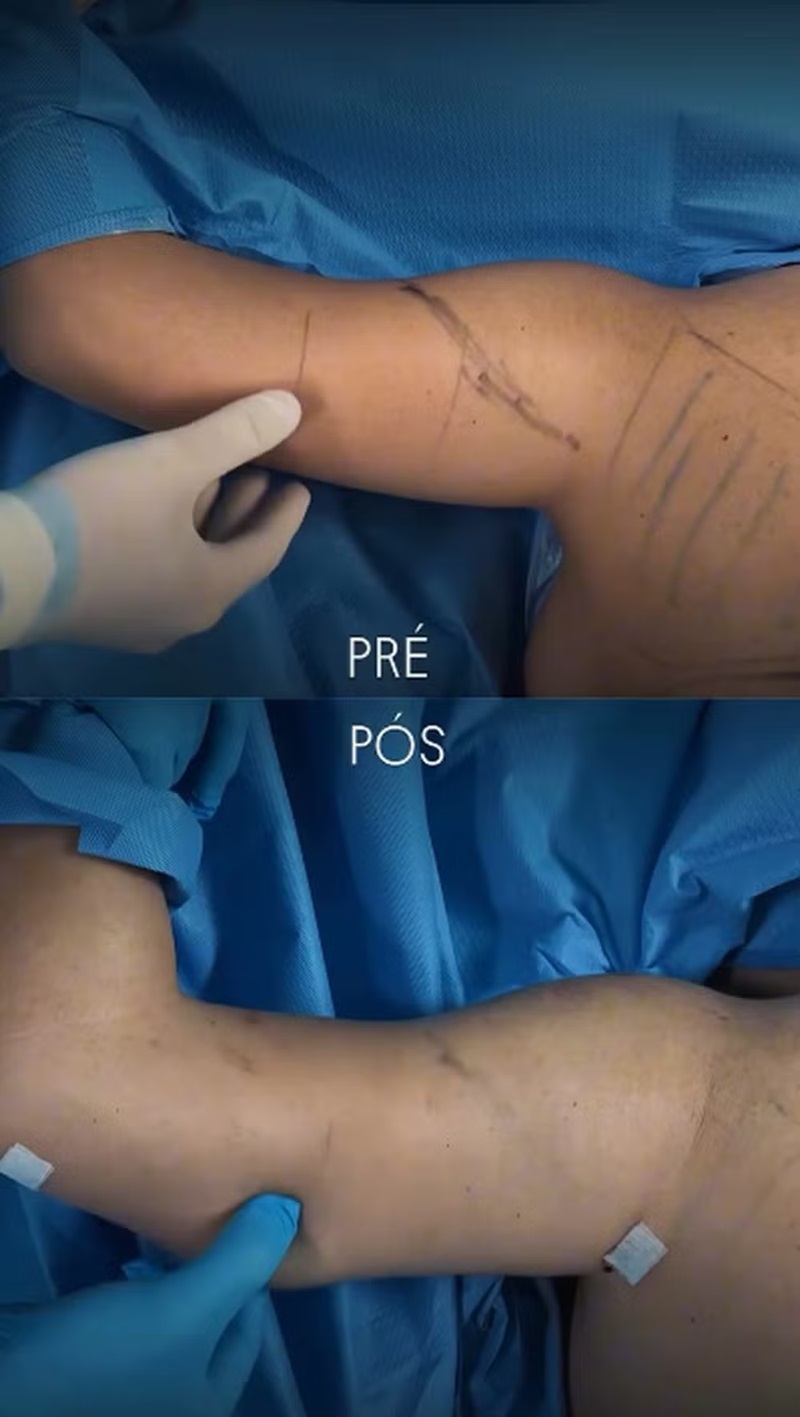 Antes e depois de Camila Moura — Foto: Reprodução/Instagram