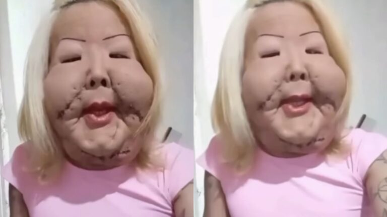 Veja o antes e depois da influenciadora que retirou óleo mineral do rosto em cirurgia