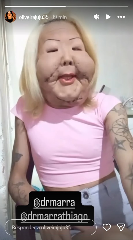 Influenciadora mostra recuperação após cirurgia no rosto - Reprodução/Instagram @oliveirajuju35