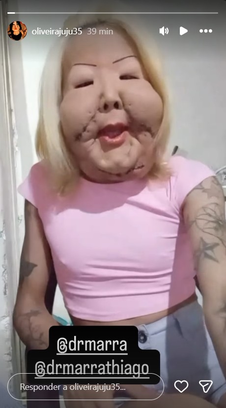 Influenciadora mostra recuperação após cirurgia no rosto - Reprodução/Instagram @oliveirajuju35