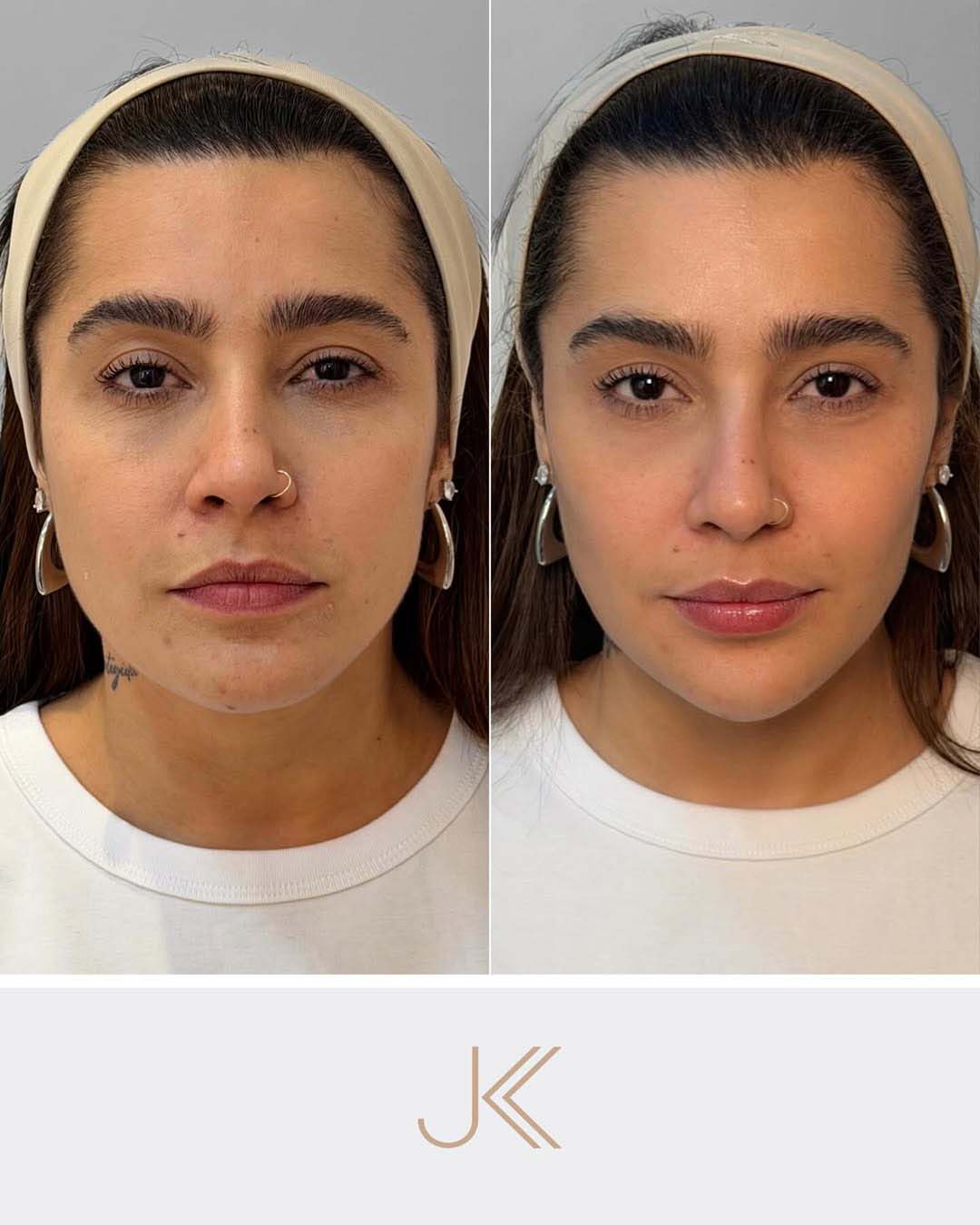 Antes e depois de Lauana Prado - Foto: Reprodução / Instagram