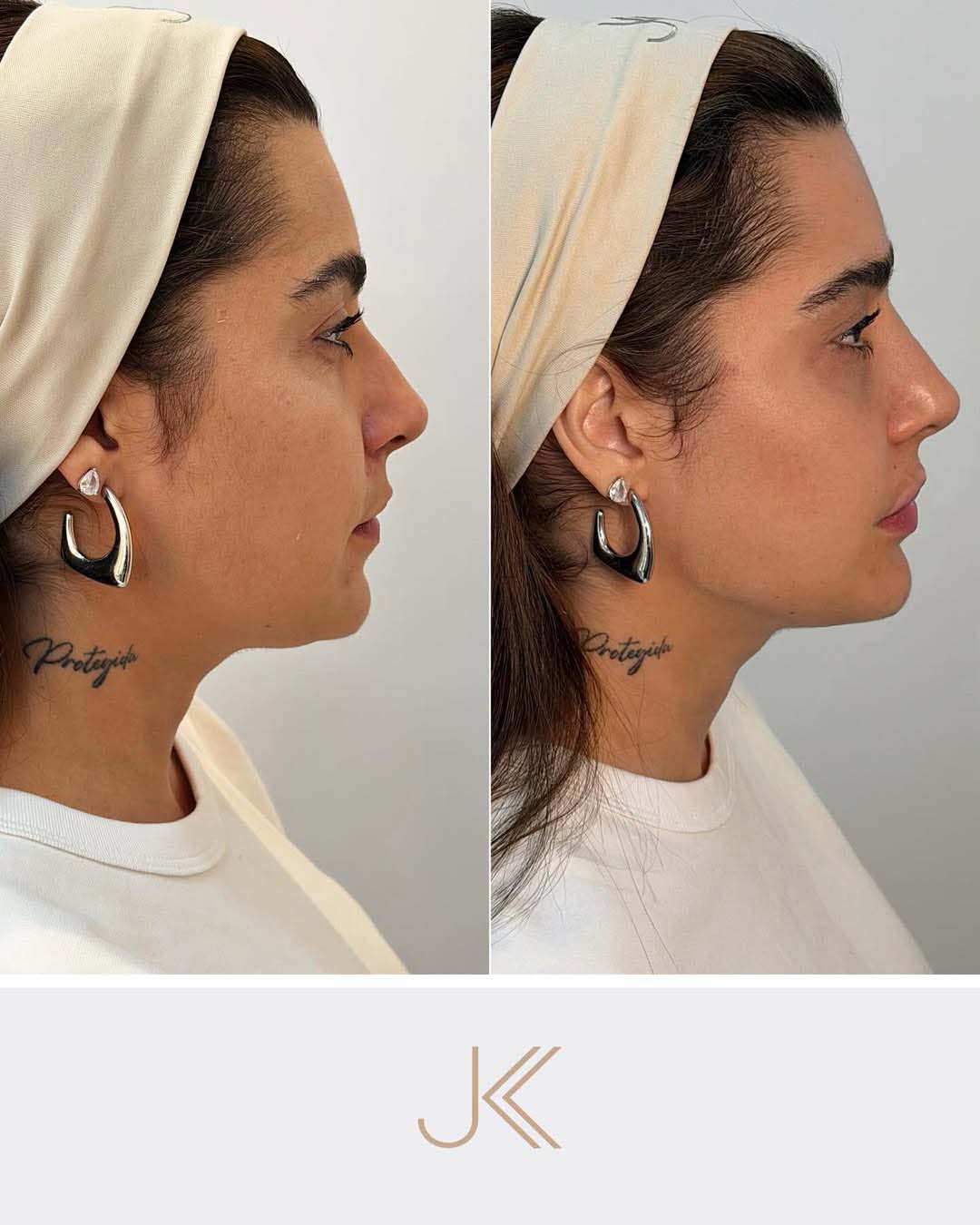 Antes e depois de Lauana Prado - Foto: Reprodução / Instagram