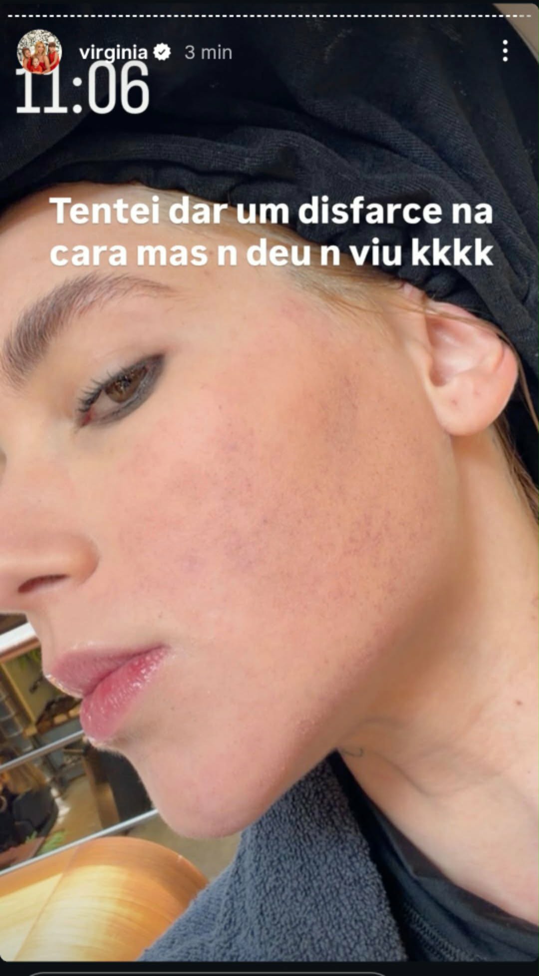 Virginia Fonseca impressiona ao mostrar situação de seu rosto