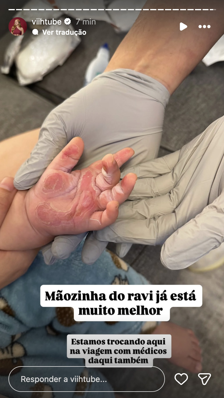 Viih Tube mostra a cicatrização da mão do filho - Foto: Reprodução / Instagram