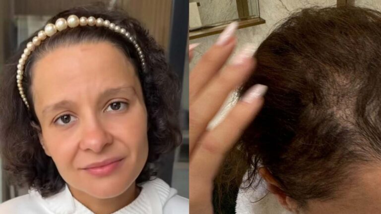 Entenda a doença que não tem cura e que quase deixou Maiara careca: ‘Problema genético’