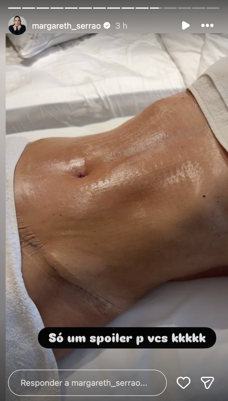 Barriga de Margareth Serrão após a abdominoplastia - Foto: Reprodução / Instagram