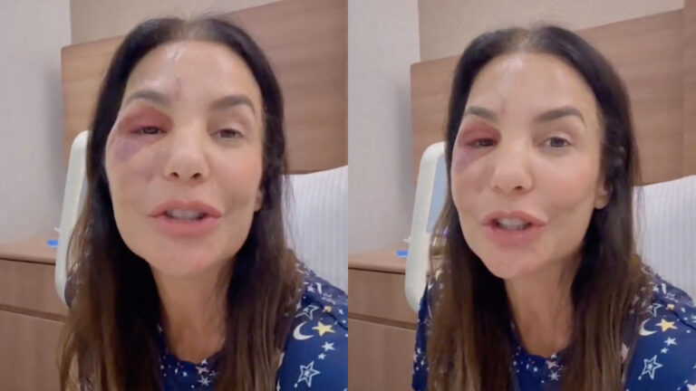Ivete Sangalo surge com o rosto inchado após cirurgia: ‘Poderia ter sido muito pior’
