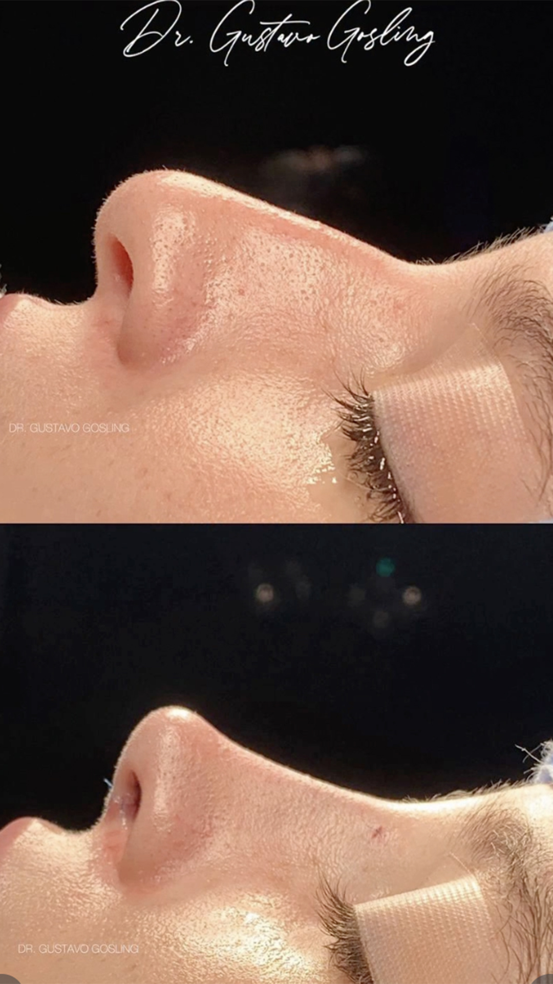 Antes e depois da cirurgia de Sophia Valverde no nariz - Foto: Reprodução / Instagram