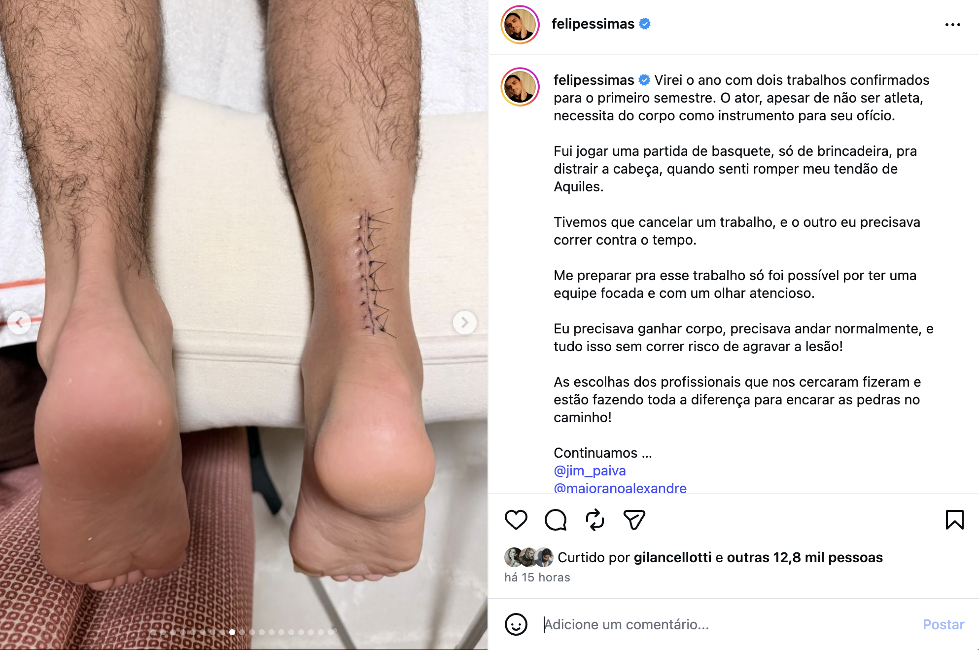 Cicatriz de Felipe Simas - Foto: Reprodução / Instagram