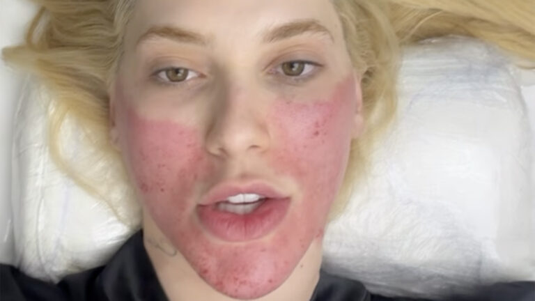 Aos 27 anos, Virginia fica com o rosto vermelho após tratamento. Saiba o que é