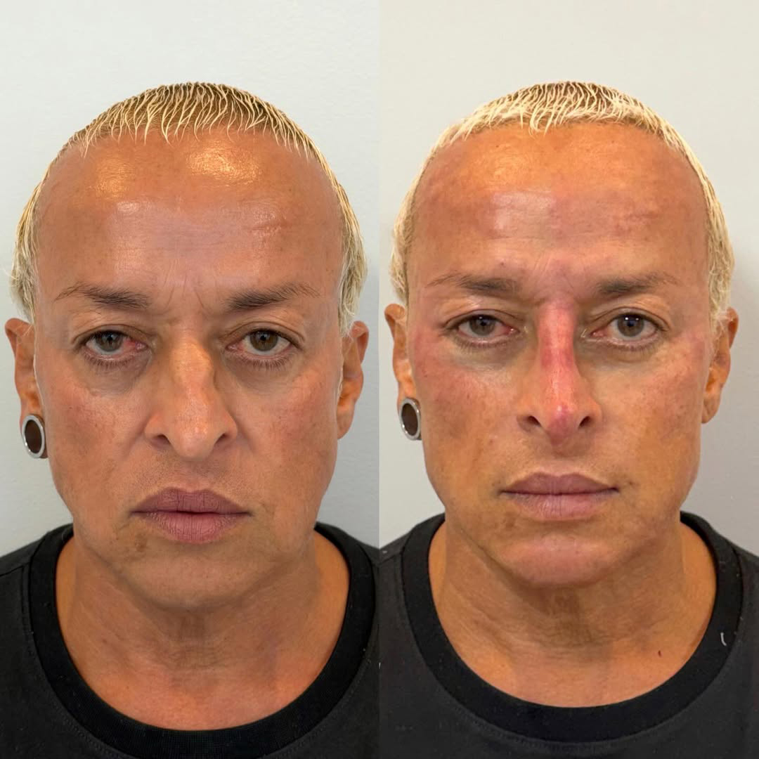 Antes e depois de Walério Araújo - Foto: Reprodução / Instagram