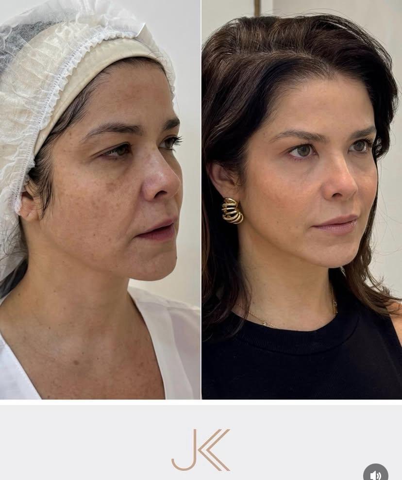 Antes e depois de Samara Felippo - Fotos: Reprodução/Instagram