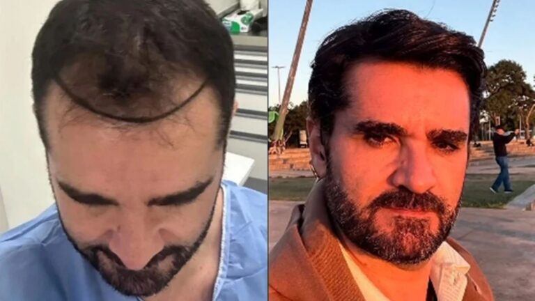 Jornalista da GloboNews compartilha processo de crescimento dos fios após transplante capilar; entenda