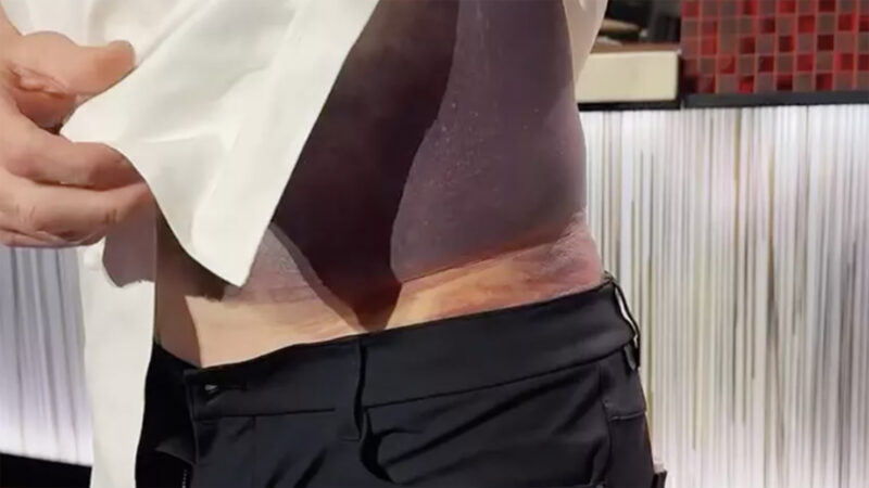 Aos 59 anos, apresentador bilionário ficou com hematoma gigante após acidente: ‘Sorte de estar aqui’