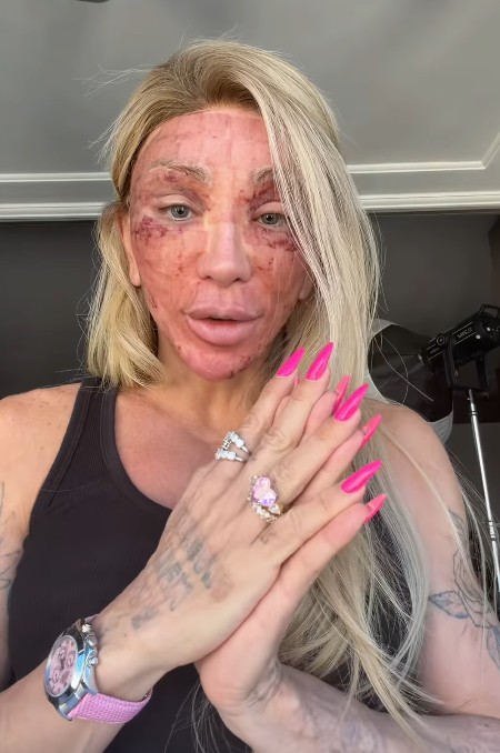 Maya Massafera mostra estado do rosto após procedimento - Foto: Reprodução / Instagram @mayamassafera