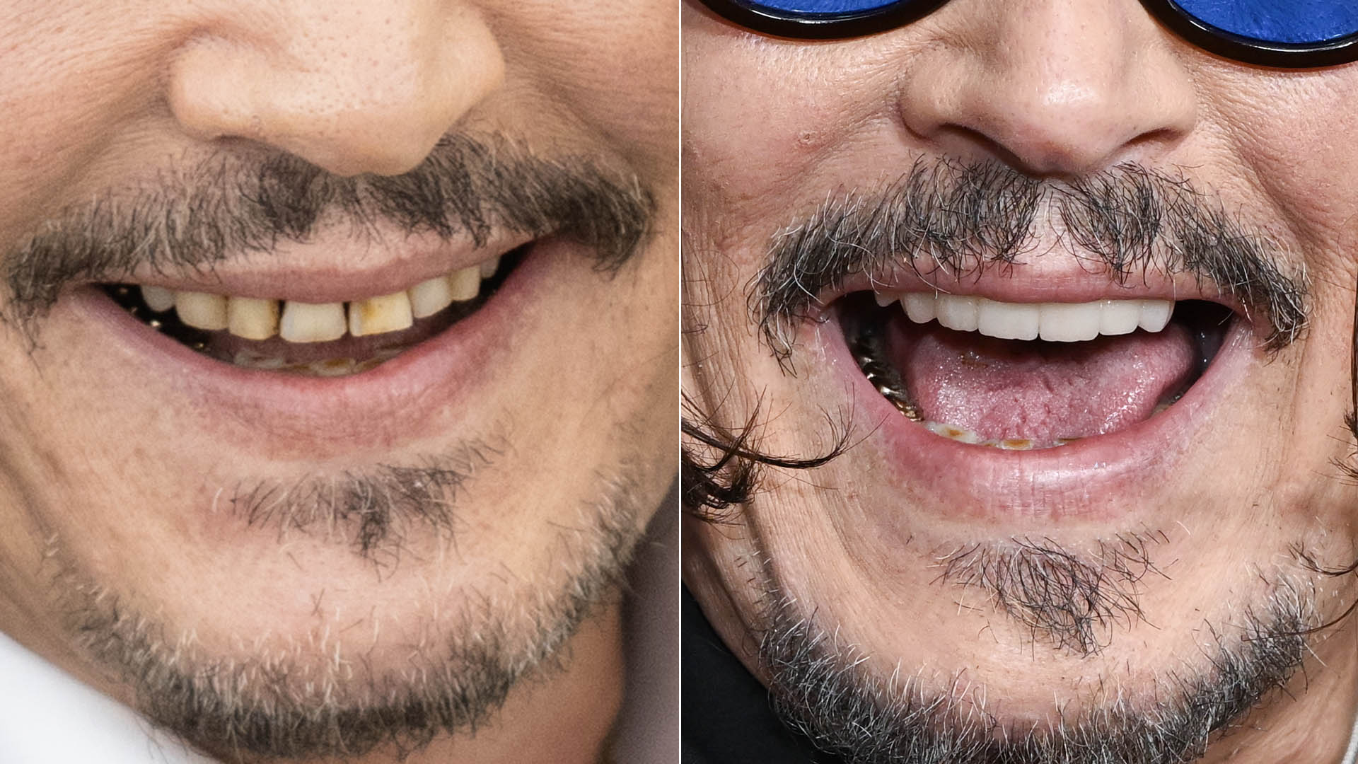 Antes e depois dos dentes de Johnny Depp - Foto: Getty Images
