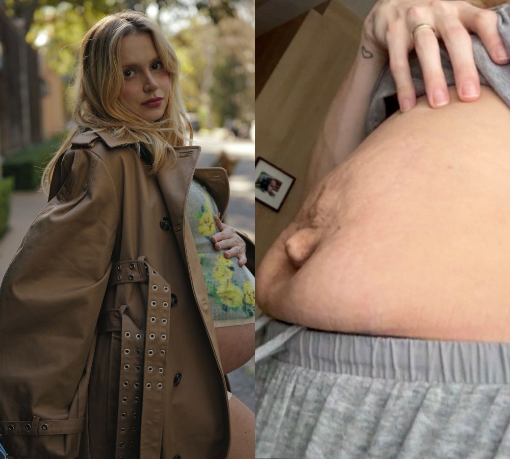 Isabella Scherer realizará procedimento para corrigir cicatriz de parto - Foto: Reprodução/Instagram