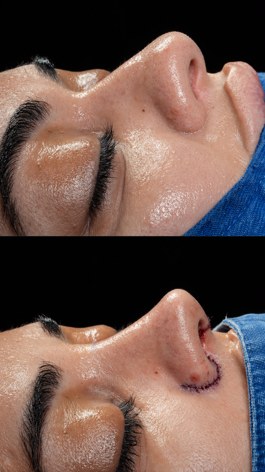 Antes e depois da cirurgia de rinoplastia de Flávia Correia - Foto: Drrec.mkt