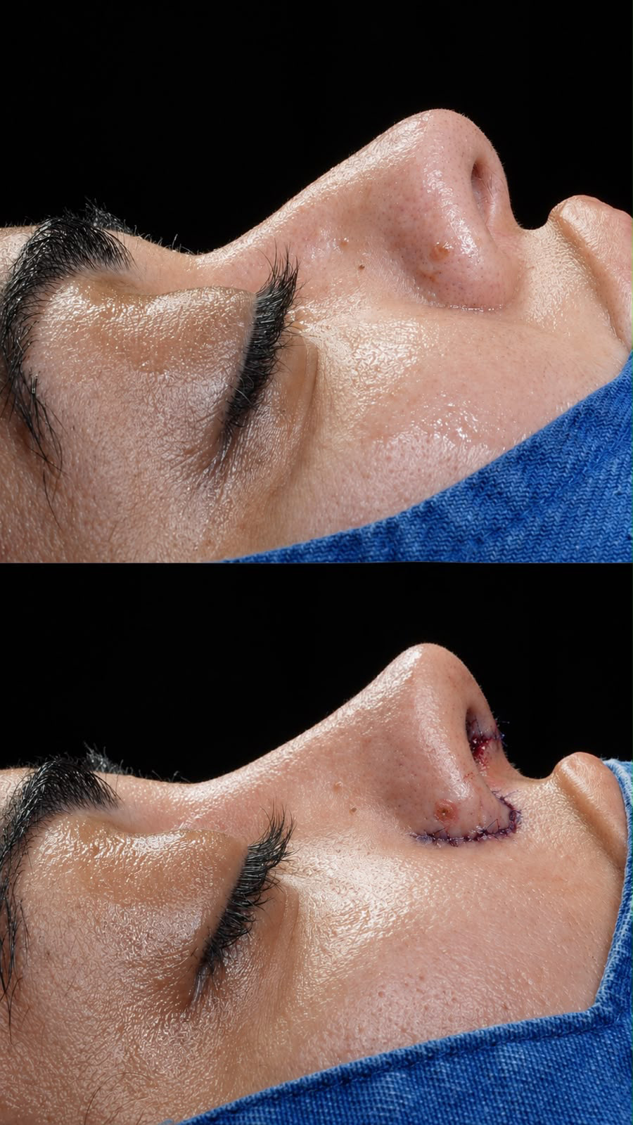 Antes e depois da cirurgia de rinoplastia de Flávia Correia - Foto: Drrec.mkt