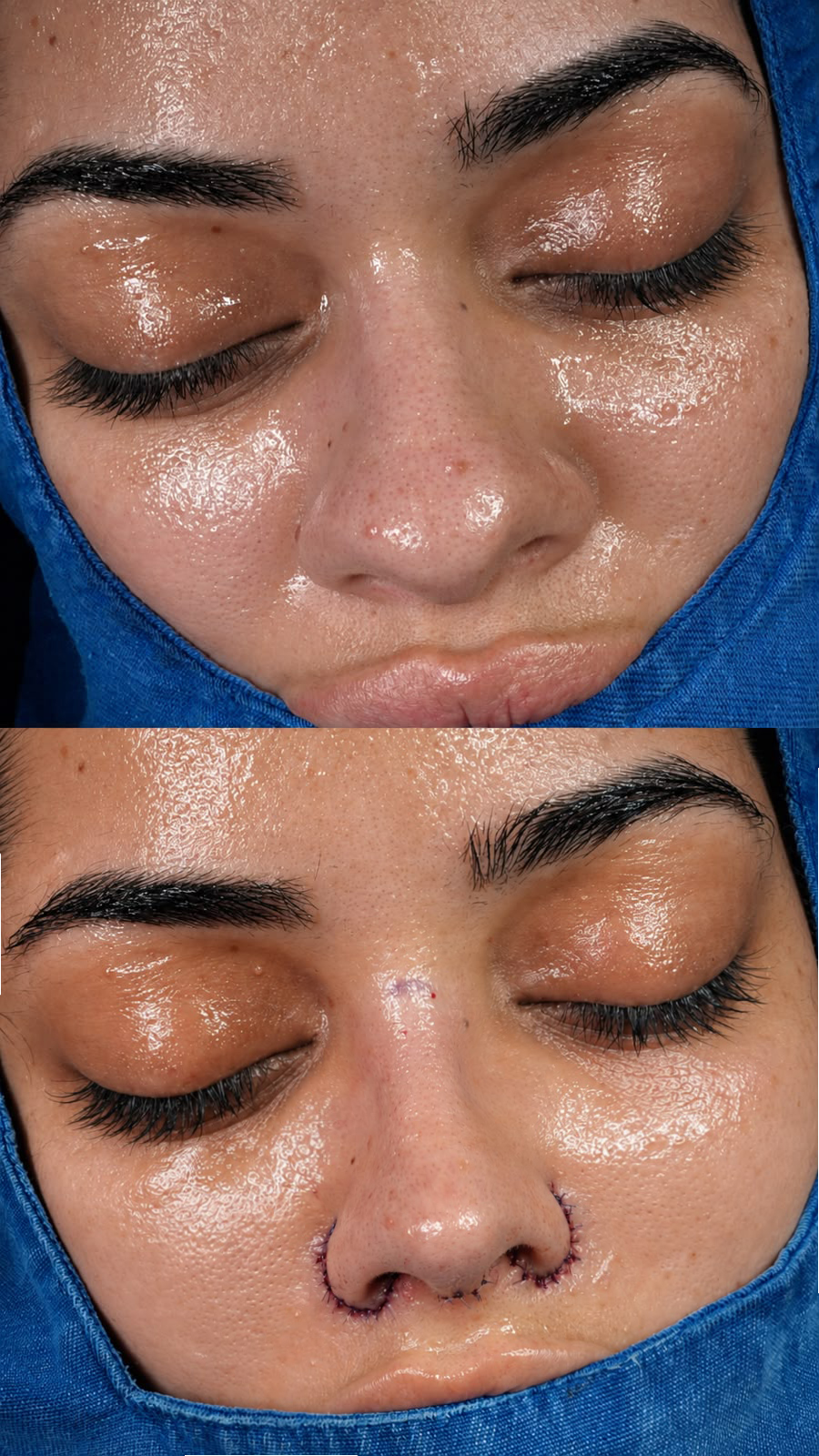 Antes e depois da cirurgia de rinoplastia de Flávia Correia - Foto: Drrec.mkt