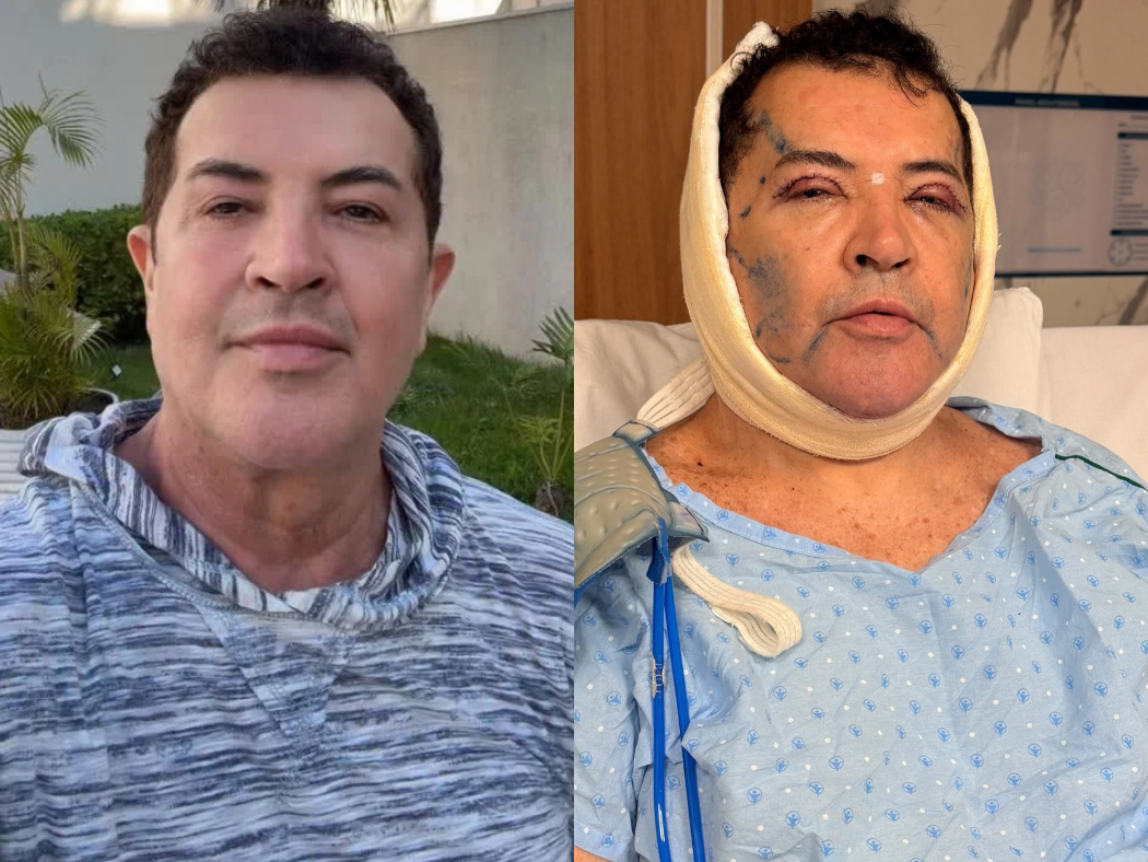 Antes e depois da cirurgia plástica de Beto Barbosa - Foto: Reprodução/Instagram