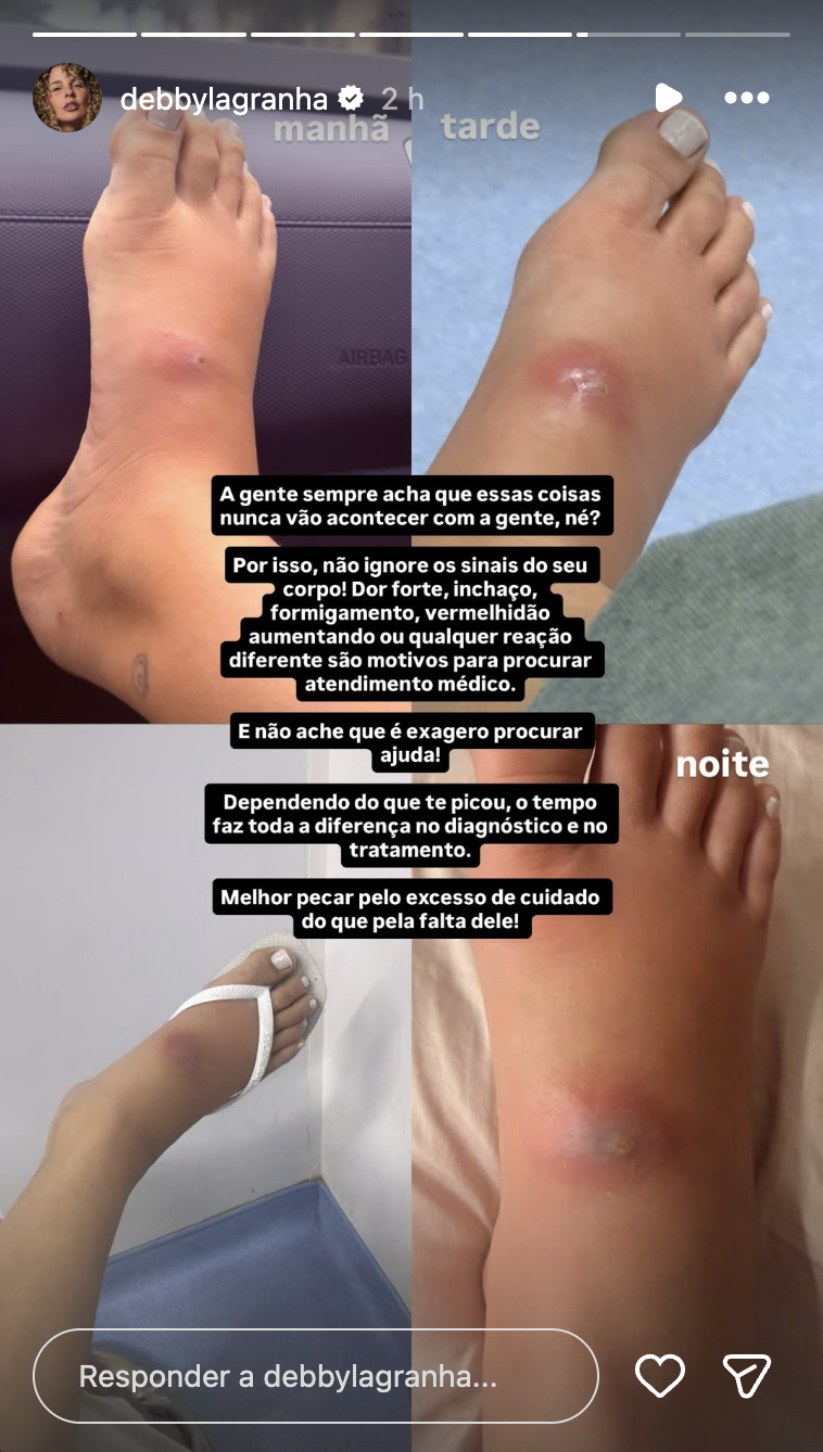 Pé de Debby Lagranha após picada de aranha - Foto: Reprodução / Instagram