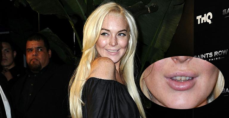 Lindsay Lohan surge com dentes sujos e amarelados