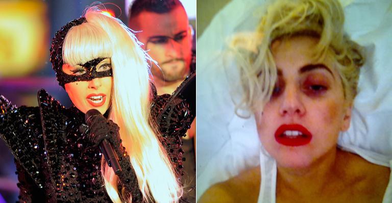 Lady Gaga mostra foto de olho roxo após acidente em show