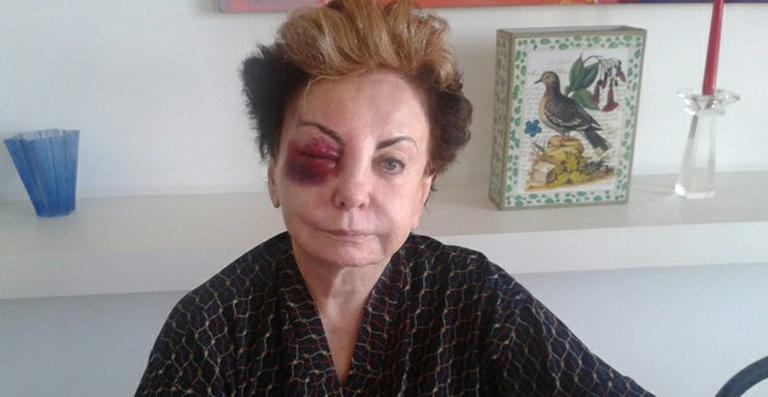 Após acidente, Beatriz Segall passa aniversário em repouso
