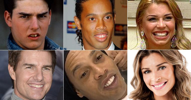 Transformação! Veja como eram os dentes dos famosos!