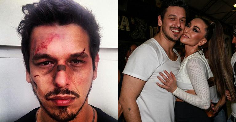 João Vicente, namorado de Sabrina Sato, grava esquete do Porta dos Fundos com rosto machucado