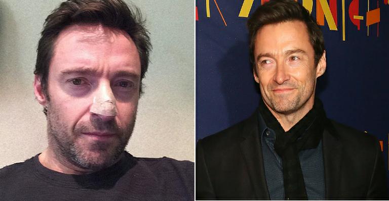 O ator australiano Hugh Jackman faz tratamento contra câncer de pele