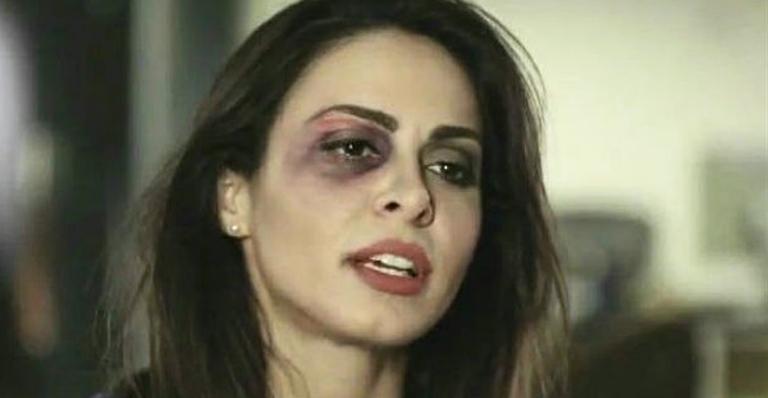 Alinne Rosa explica o motivo do olho roxo: Fizeram piada, chacota
