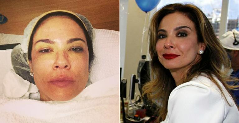 Sem maquiagem, Luciana Gimenez faz procedimento estético e mostra na web