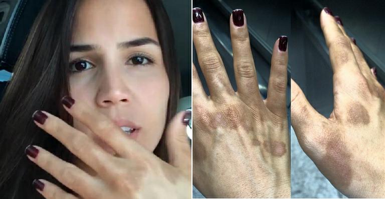 Pérola Faria sofre queimaduras nas mãos e faz alerta para os fãs