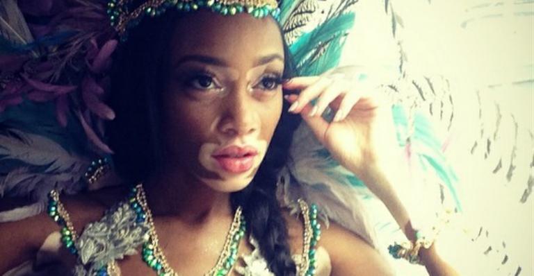 Chantelle Brown, modelo com vitiligo, estará na próxima temporada de America’s Next Top Model