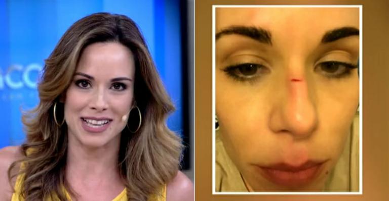 Ana Furtado revela ter sofrido acidente doméstico: “Dei de cara em uma porta de vidro”