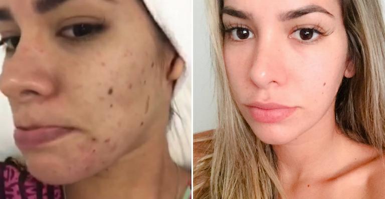 Adriana Santanna mostra vídeo de seu rosto e impressiona fãs: “Minha pele é ruim”