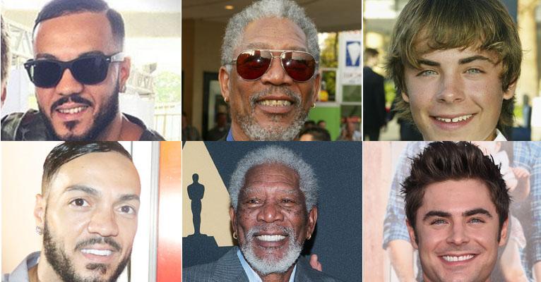 Sorriso: Assim como Belo, veja os famosos que mudaram completamente os dentes
