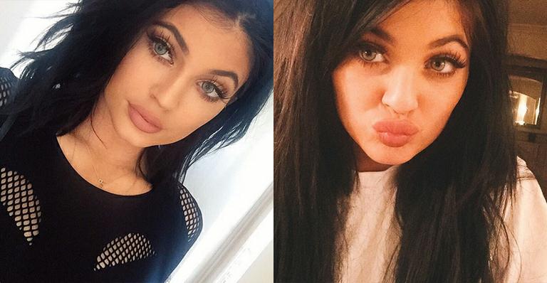 Kylie Jenner faz alerta após meninas se machucarem tentando ‘imitar’ seus lábios