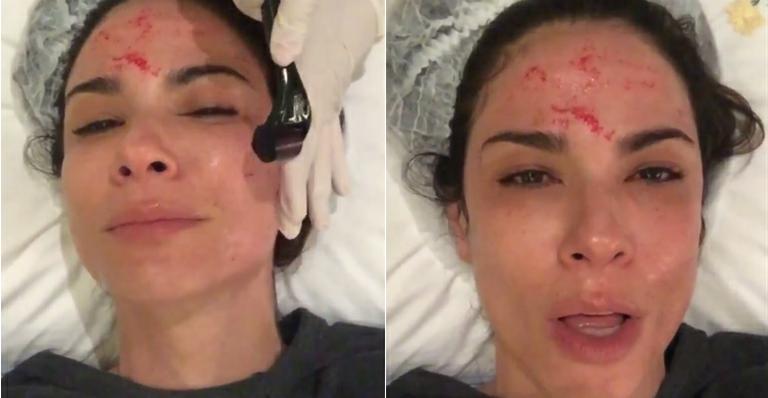 Com sangue no rosto, Luciana Gimenez reclama de dor em tratamento de beleza