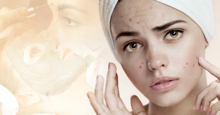 Dicas infalíveis para combater as espinhas