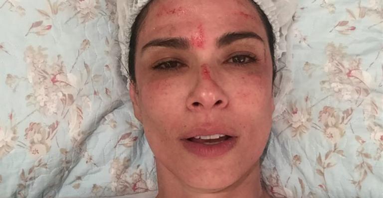 Luciana Gimenez aparece com o rosto sangrando em tratamento de beleza