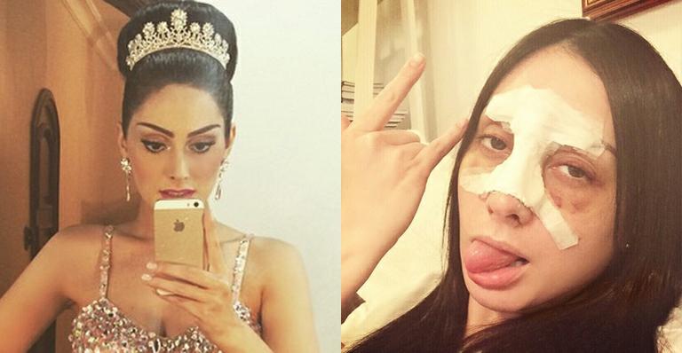 Ex-BBB Francine Piaia mostra o rosto após fraturar nariz em acidente de carro