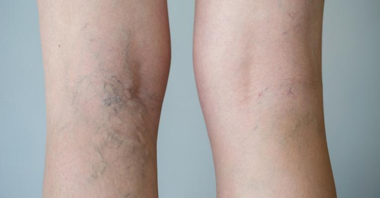 Tratar varizes no verão requer mais cuidados; médico explica